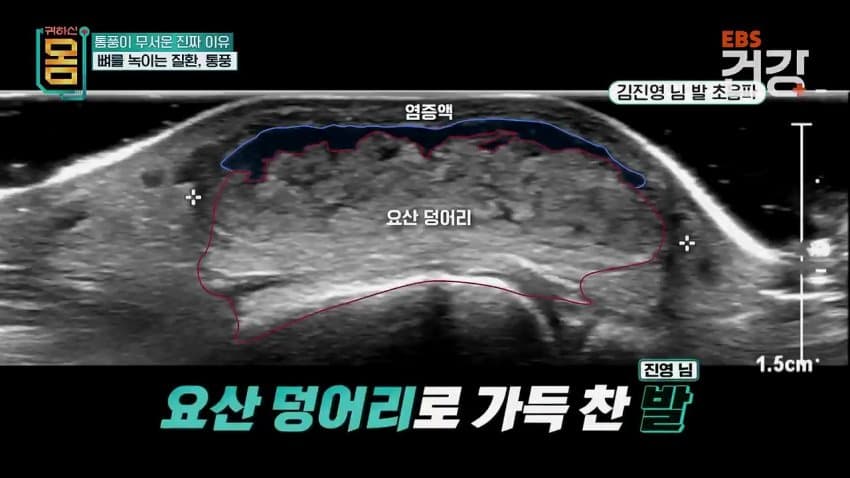 30대 통풍 환자의 발상태.ㄷㄷ