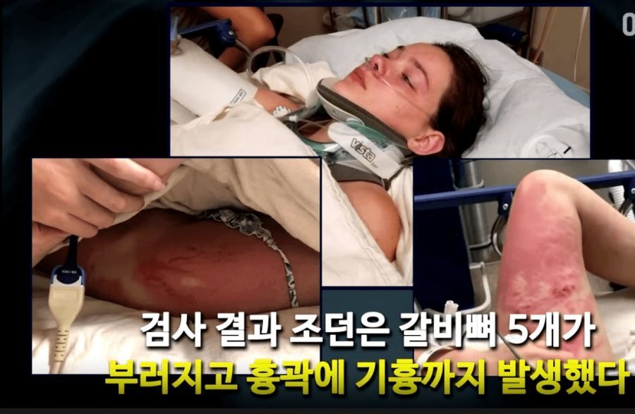 친구 밀어버린 미친년
