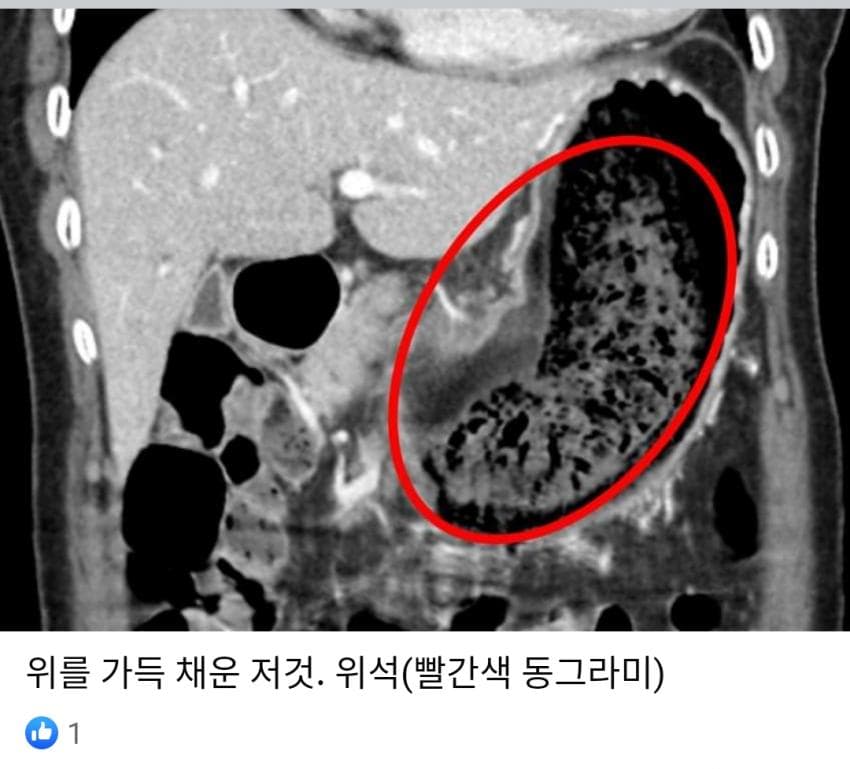 혐)한 의사의 위석 제거 썰