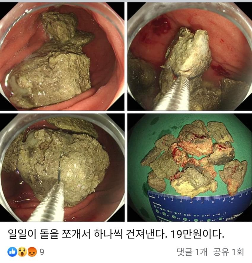 혐)한 의사의 위석 제거 썰
