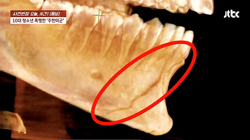 주한 미군 주먹에 10대 학생 '턱뼈' 부 서져