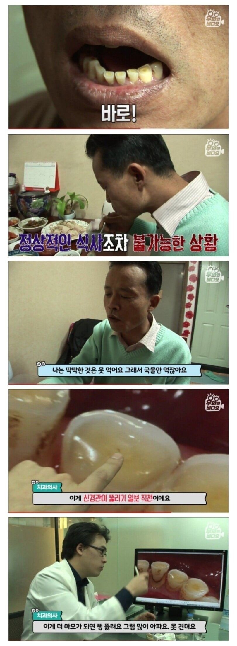 20년간 이갈이 한 사람의 치아 상태
