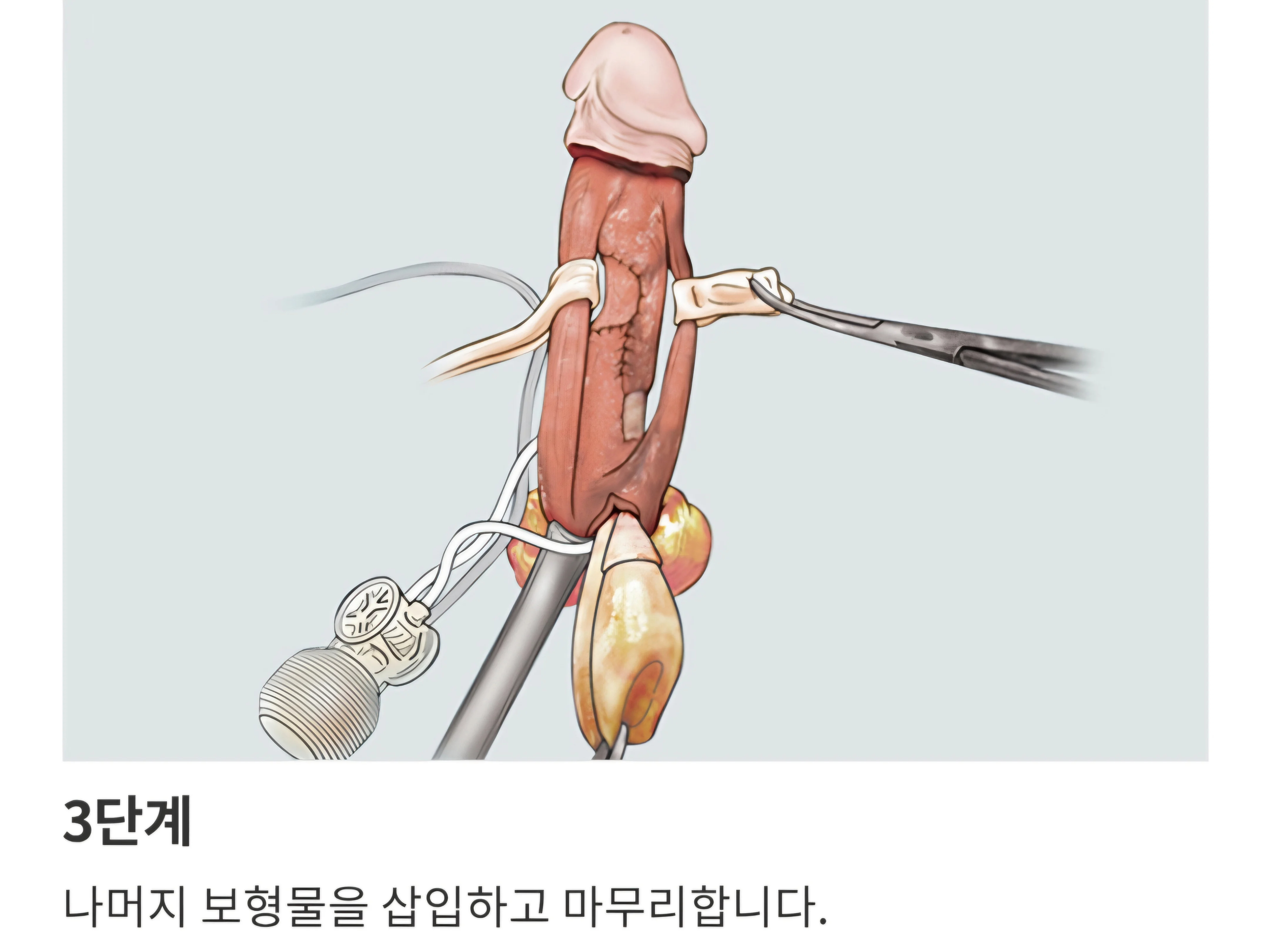 발기부전일때 최후의 선택지