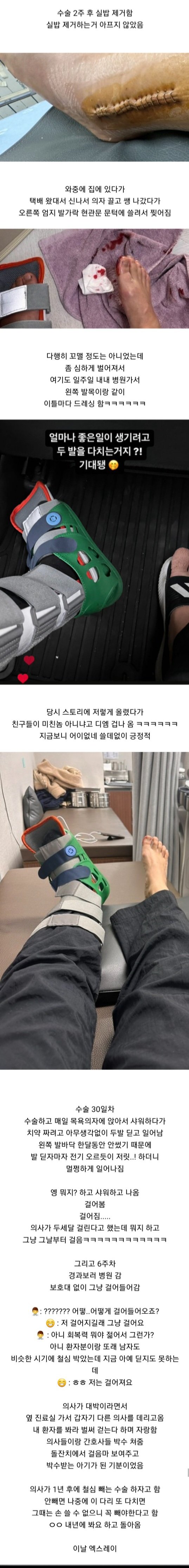 발목 부러졌는데 하나도 안아프다는 여자의 11개월 뒤 ㄷㄷ