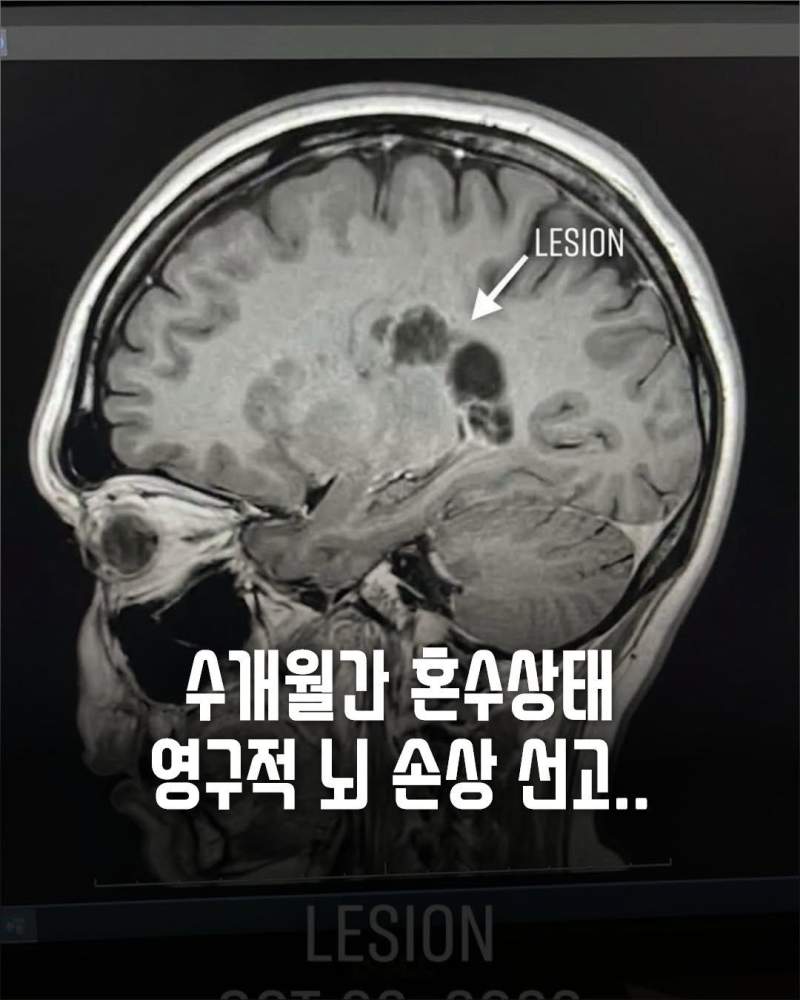 40 대 남성 생굴먹고 심정지에 뇌손상